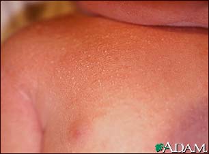 Heat Rash or Prickly Heat (Miliaria Rubra) in an Infant or ...